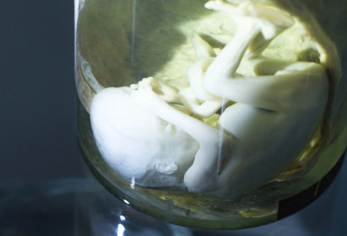 의료연구소에 보관된 태어나지 않은 태아 사진         (기사와 직접적인 관계 없음)